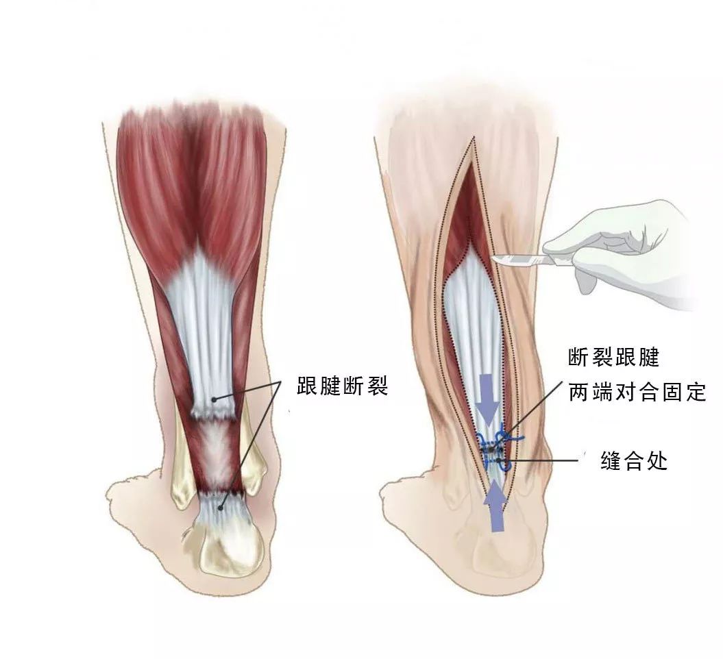 杜兰特跟腱断裂他还能回到赛场吗