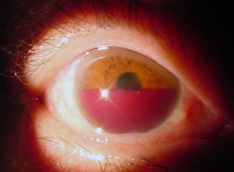 轻损害(不影响视力和功能):眼周浅Ⅰ度热烧伤,眼球前房积血.