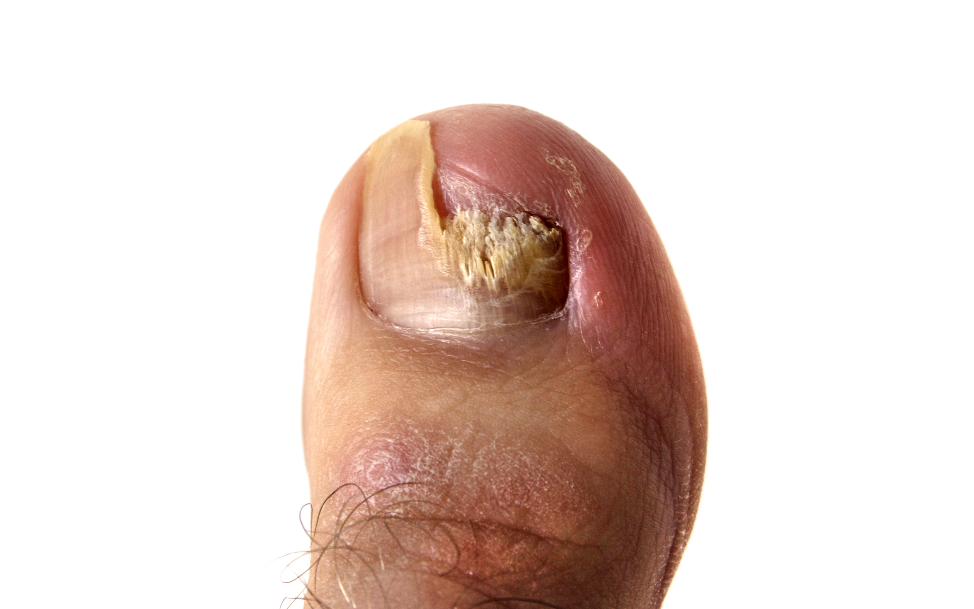 灰指甲重度症状图片图片