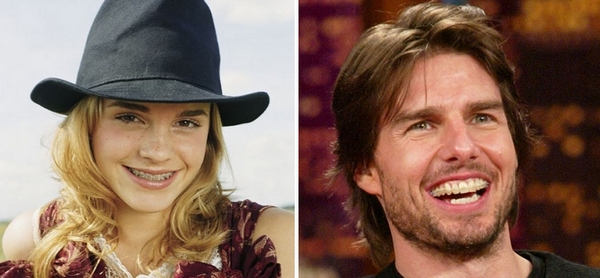 图片来自：weasleyovi.blog.cz&forumshot.com。左图：正在接受正畸治疗的Emma Watson。右图：正在进行正畸治疗的Tom Cruise。