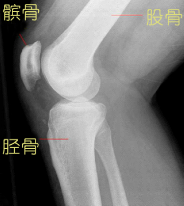 膝关节X光片（矢状面）。