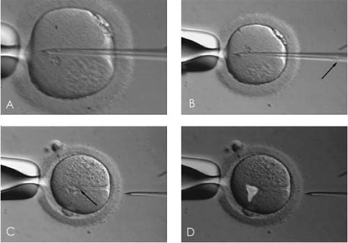 细胞质移植技术，给受体卵细胞注入部分供体卵子的细胞质。D中亮白色的部分是来自第三方卵子的细胞质，约占整个细胞质的7%-14%。来源：[4]