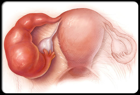 图中发红、肿胀的输卵管。