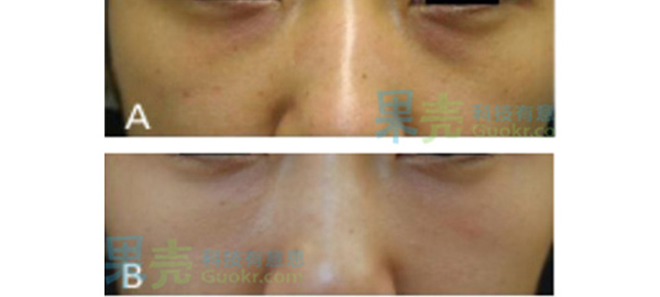 血管型黑眼圈.A）治疗前紫红色区域以及凹陷的泪沟清晰可见 B)自体脂肪移植后得到改善。