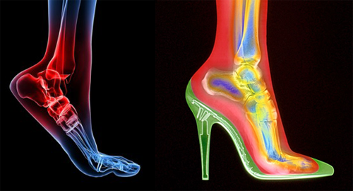 左：足尖向下的跖屈运动，图片来自：footphysics.co.uk；右：高跟鞋里的脚，图片来自：shephardchiro.com。