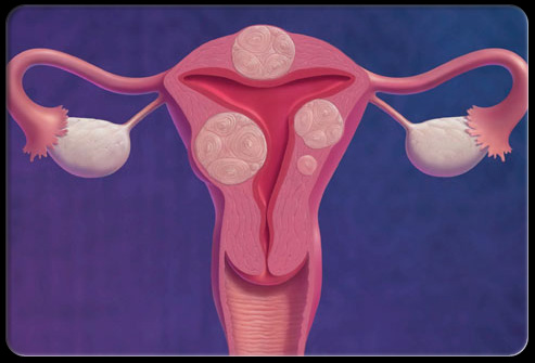子宫壁内的子宫肌瘤。