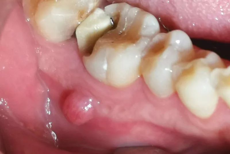 牙龈上的鼓包是根尖周炎的一个症状丨作者供图